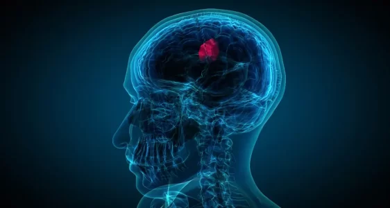 Beyin-Tumorleri-GBM-Menenjiom-Metastaz