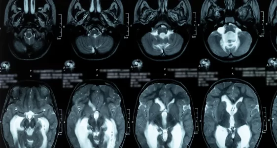 Hidrosefali-ve-Sant-Uygulamalari