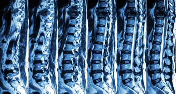 Omurilik Kırıkları ve Stabilizasyon Ameliyatları