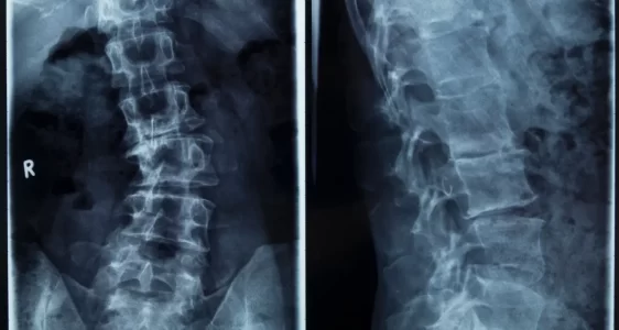 Skolyoz ve Kifoz Cerrahisi (Vidalı Düzeltme)