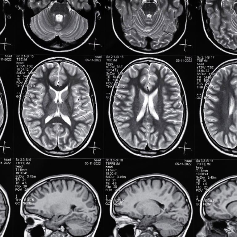 Beyin Tümörleri Tedavisi