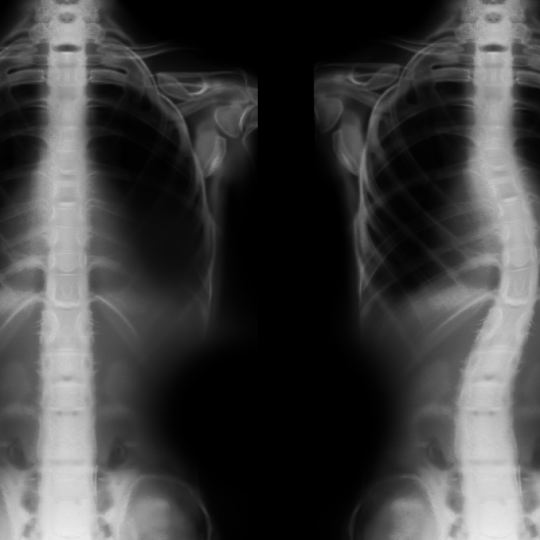 Skolyoz ve Kifoz Cerrahisi (Vidalı Düzeltme)